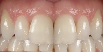 cuenca-implantes-de-dientes-ecuador