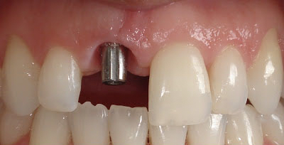 cuenca-implantes-de-dientes