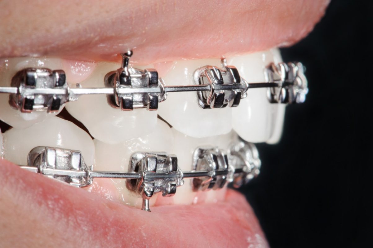 importancia-de-la-ortodoncia