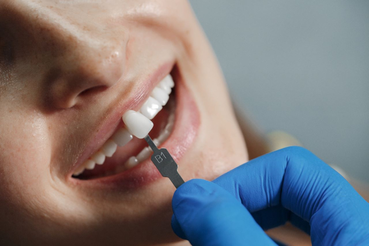 Elegir implantes dentales